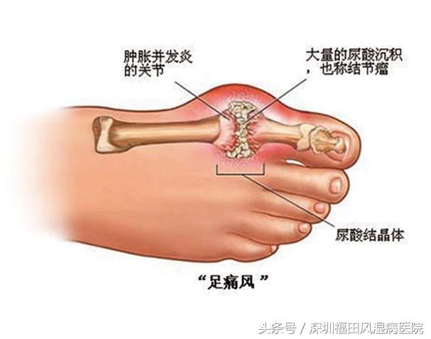 新一轮寒冷空气来袭，您有一份来自深圳市福田区风湿病专科医院的健康宝典，请查收~